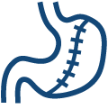 Endoskopowa gastroplastyka (ESG)