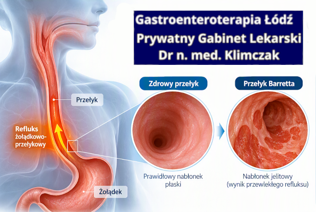 Przełyk Barretta Przełyk Barretta