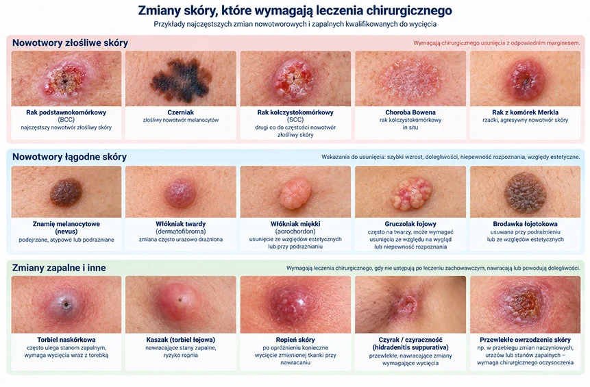 Chirirgiczne usuwanie zmian skórnych