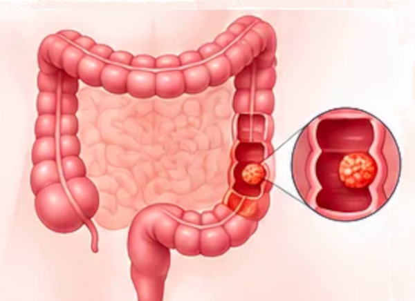 szybka ścieżka onkologiczna Łódź gastroenterolog szybka ścieżka onkologiczna Łódź gastroenterolog